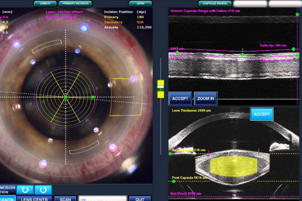 cirurgia.catarata