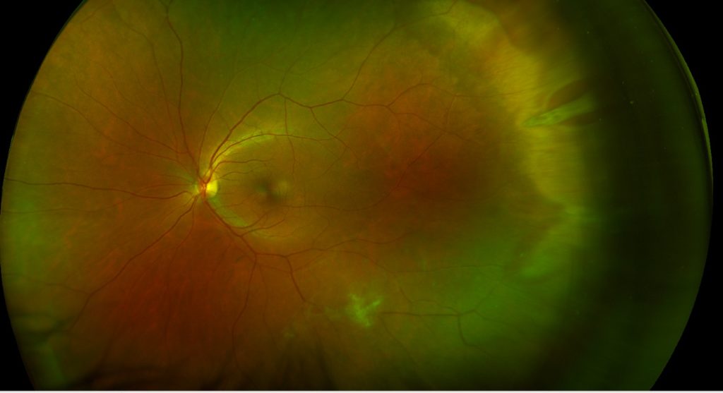 retina-optomap