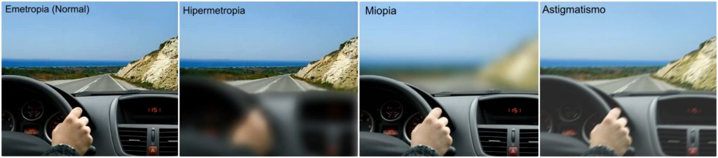 miopia.astigmatismo